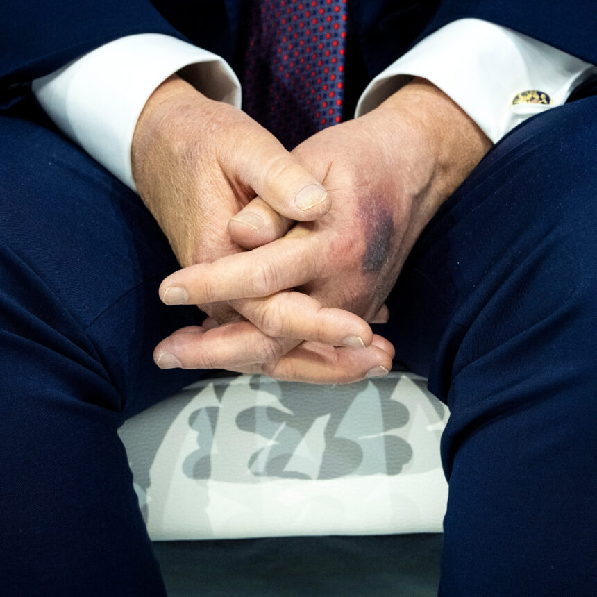Trump Says He Bruised His Hand on a Table
